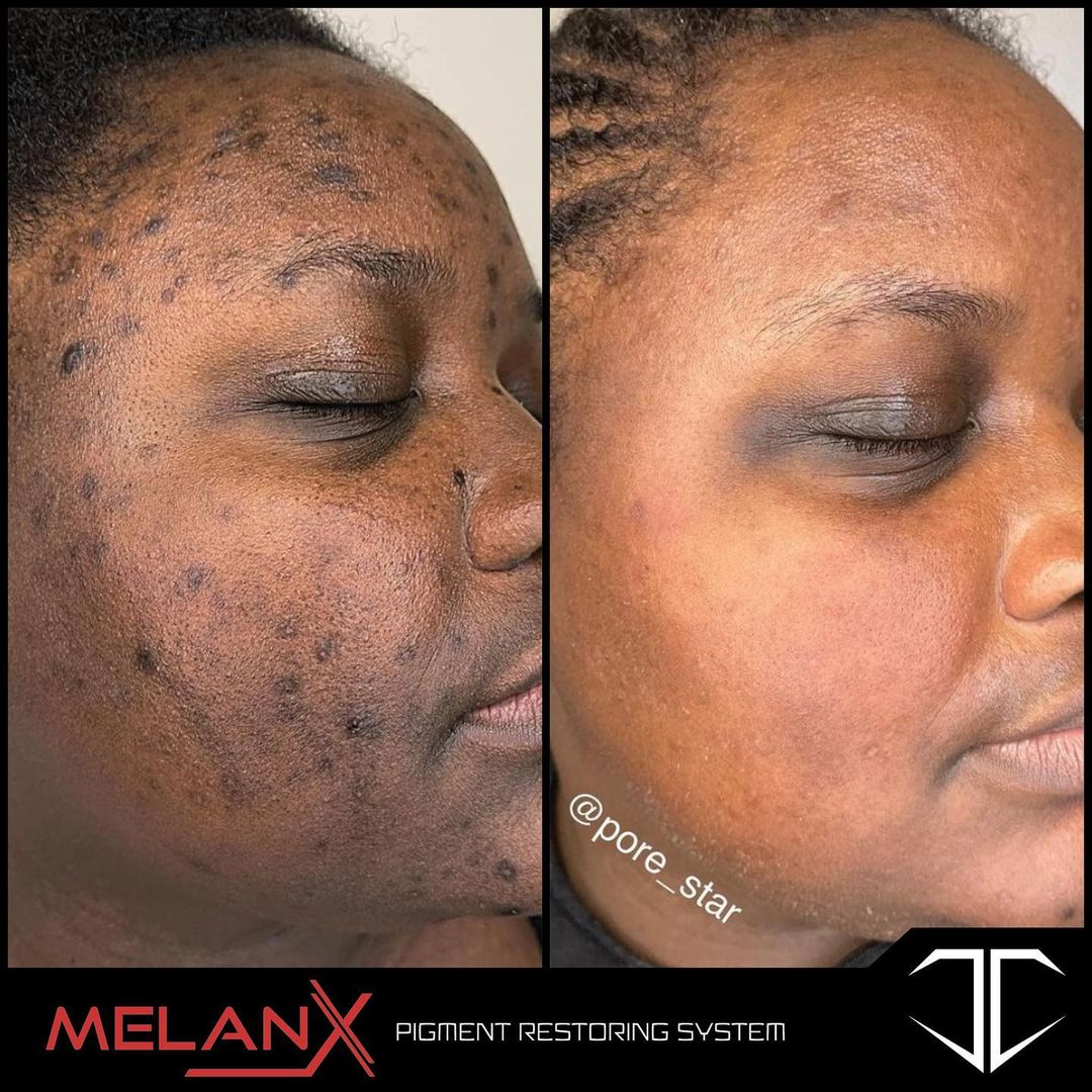 MelanX Chemical Peel | Home Use Application (Face Only)