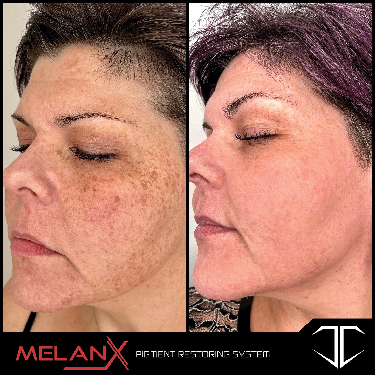 MelanX Chemical Peel | Home Use Application (Face Only)