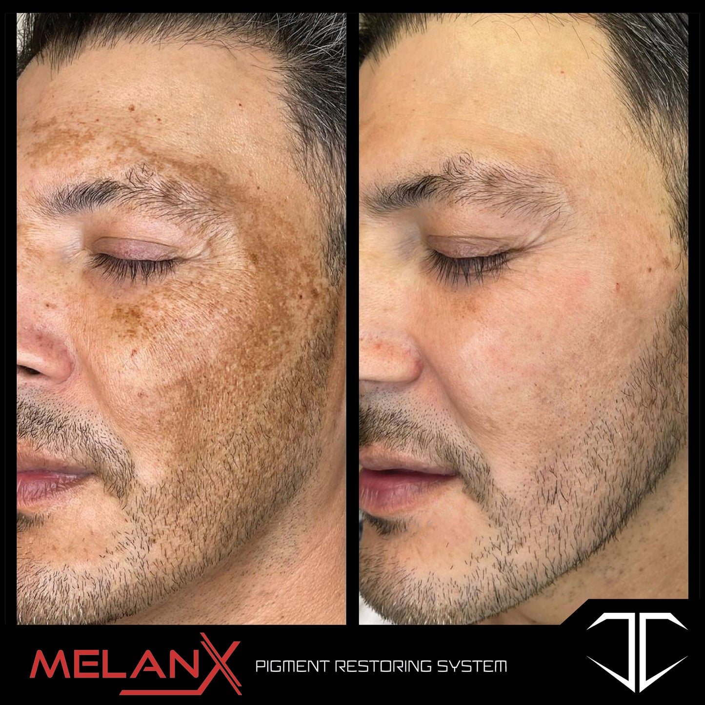 MelanX Chemical Peel | Home Use Application (Face Only)