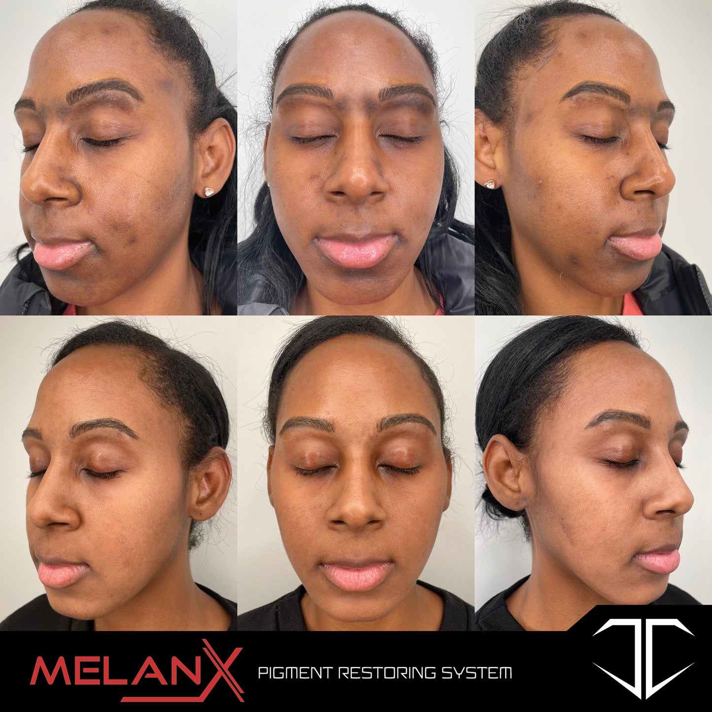 MelanX Chemical Peel | Home Use Application (Face Only)
