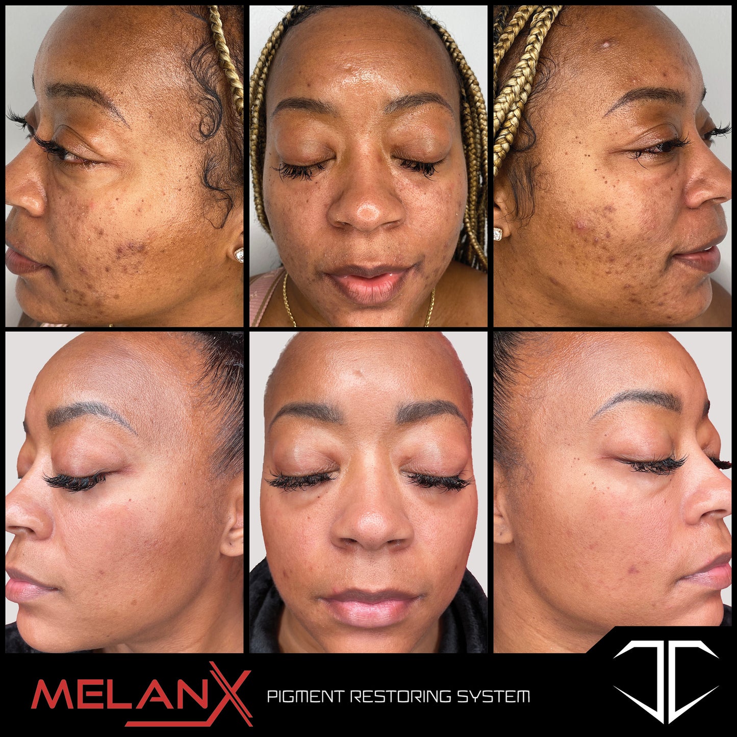 MelanX Chemical Peel | Home Use Application (Face Only)
