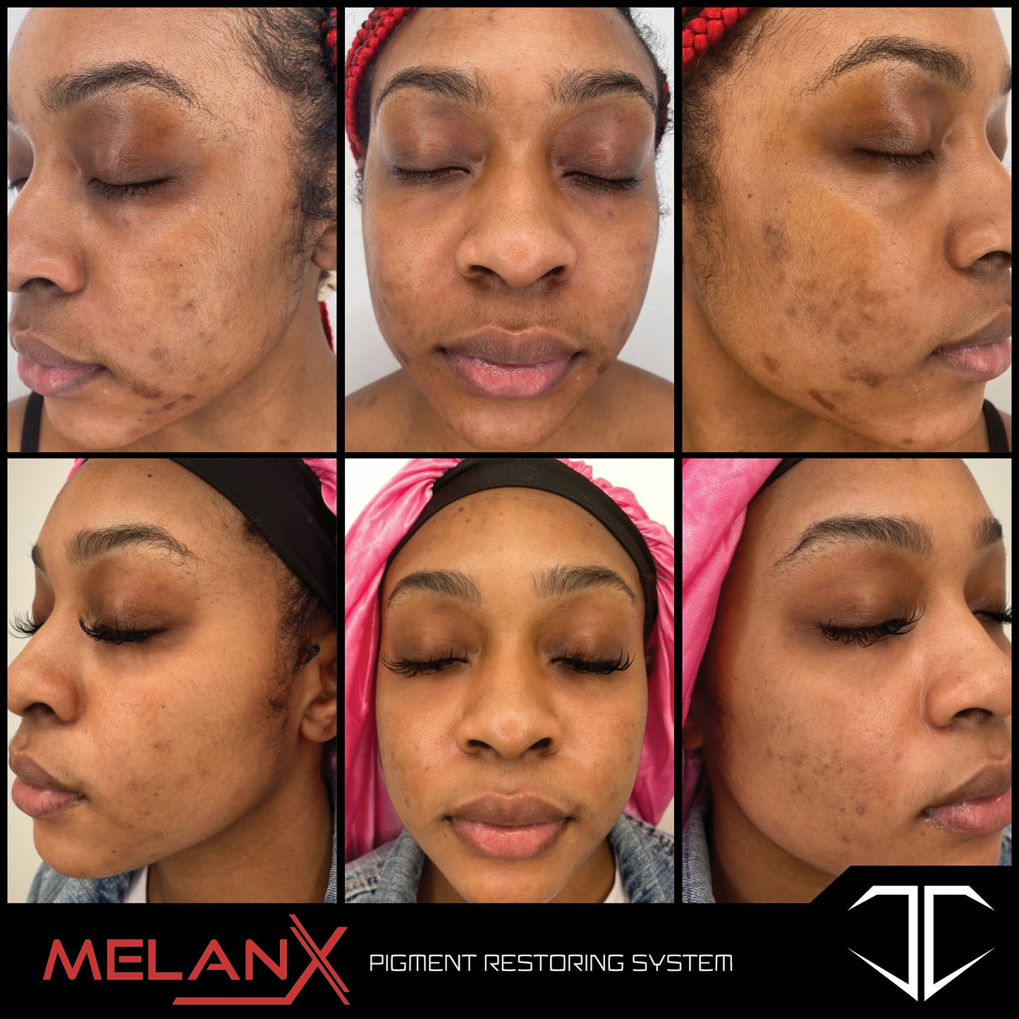 MelanX Chemical Peel | Home Use Application (Face Only)