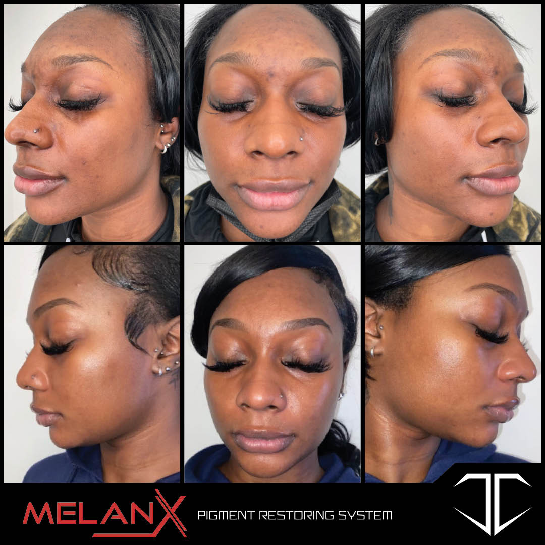 MelanX Chemical Peel | Home Use Application (Face Only)