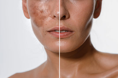 Hyperpigmentation of the Face: Understanding the Causes and How to Treat It