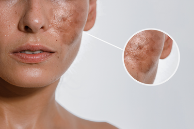 From Dark Spots to Melasma: Our Top-Rated Best Treatments for Hyperpigmentation