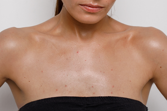 How To Get Rid Of Redness From Acne