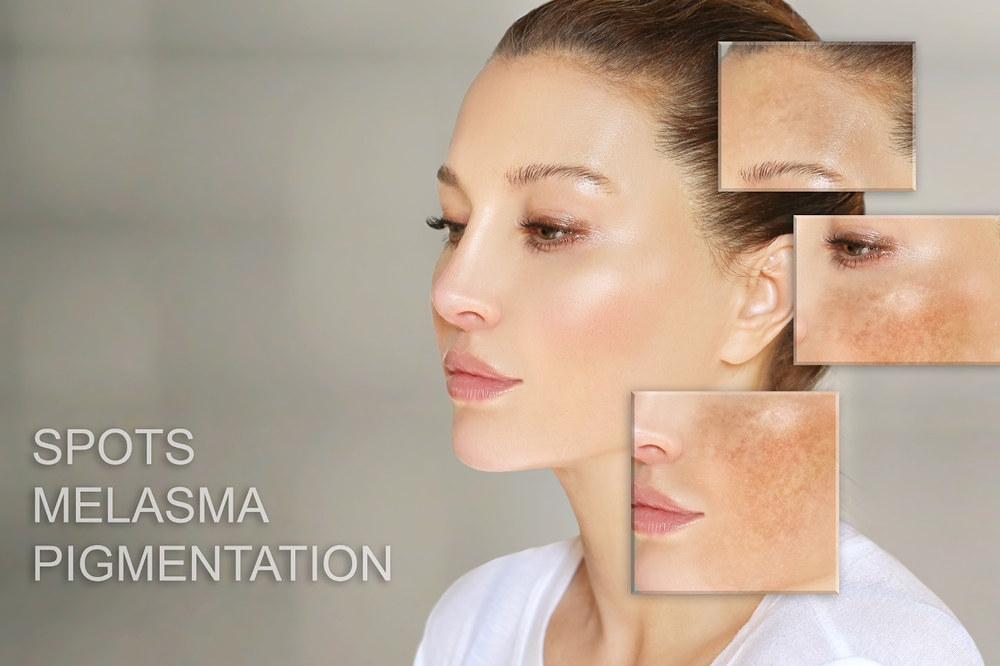 The Difference Between Melasma and Other Skin Spots