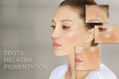 Melasma vs. Hyperpigmentation: What’s The Difference