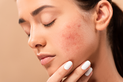 What's Causing Your Skin Irritation & How to Stop It