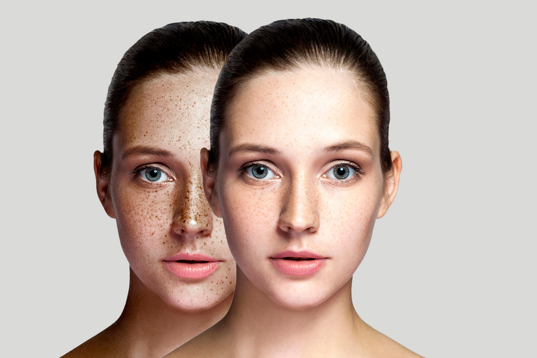 Maximizing Your Results: How to Choose the Best Products for Hyperpigmentation