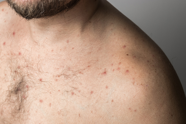 How Do You Get Rid of Shoulder Acne?