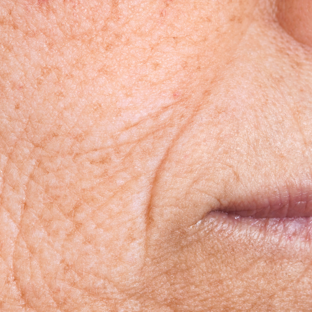 Aging Skin