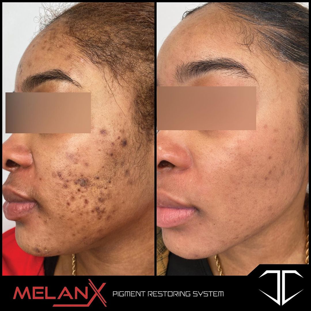 MelanX Chemical Peel | Home Use Application