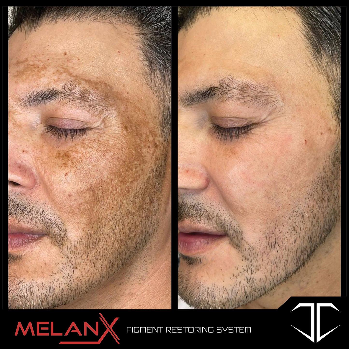 MelanX Chemical Peel | Home Use Application