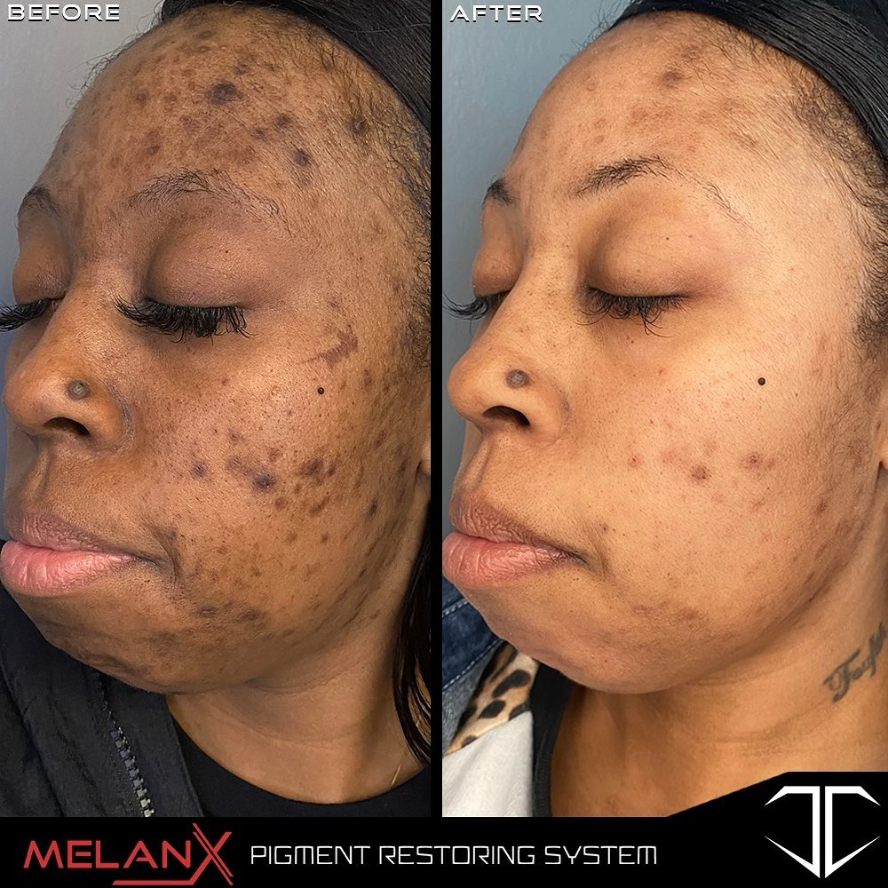 MelanX Chemical Peel | Home Use Application