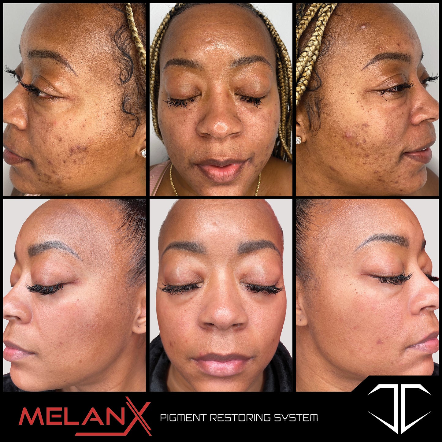 MelanX Chemical Peel | Home Use Application